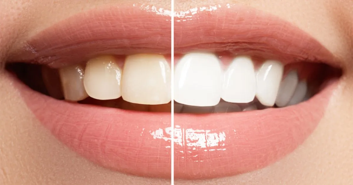 Teeth Whitening Aftercare: How to Keep Your Teeth White